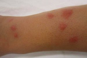 Red, irritated skin