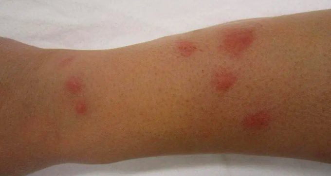 bed bug bites